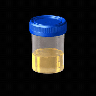 A Clear Container With A Blue Lid Filled With Urine GIF