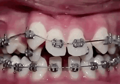 A Close Up Of A Person 'S Teeth With Braces GIF