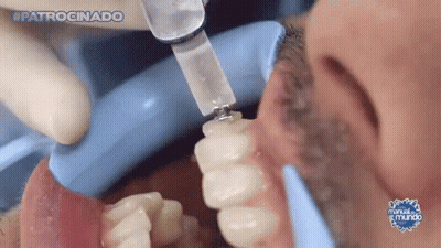A Close Up Of A Person 'S Teeth With The Words #Patrocinado On The Bottom Right GIF
