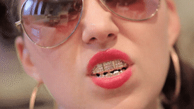 A Close Up Of A Woman Wearing Sunglasses And Braces GIF