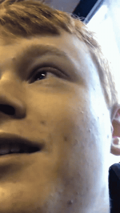 A Close Up Of A Young Man 'S Face With A Few Spots On It GIF