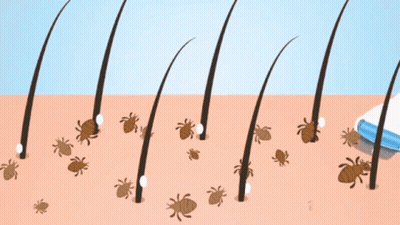 A Comb Is Being Used To Remove Lice From A Persons Hair GIF