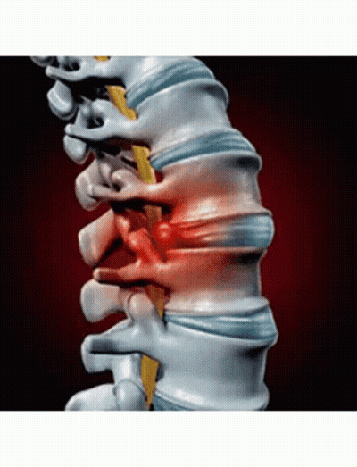 A Computer Generated Image Of A Person 'S Spine Showing A Disc In The Back Of The Spine . GIF