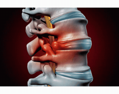 A Computer Generated Image Of A Person 'S Spine With A Red Bump On It GIF