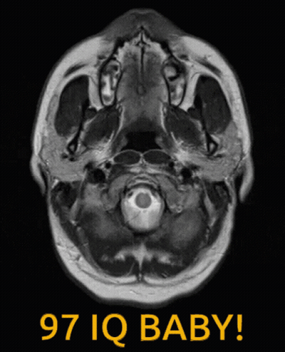 A Mri Scan Of A Baby 'S Head With The Words 97 Iq Baby Below It GIF
