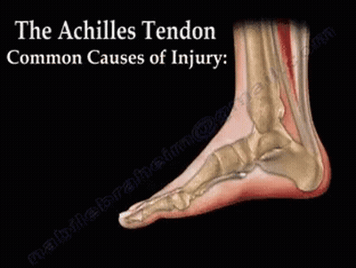 A Picture Of A Foot With The Words " The Achilles Tendon Common Causes Of Injury " On It GIF