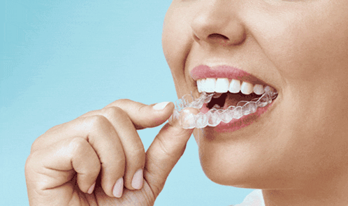 A Picture Of A Woman 'S Teeth With The Words New Orthodontic Aligners GIF