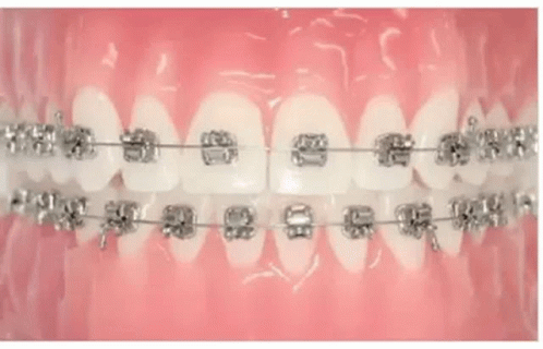 A Woman Is Wearing A Clear Retainer In Her Mouth . GIF