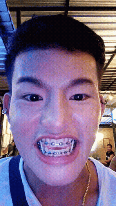 A Young Man With Braces On His Teeth Looks At The Camera GIF