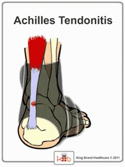 Achilles Tendonitis Diagram Bones And Muscles GIF