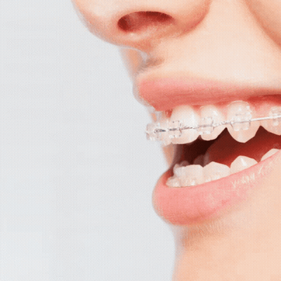 An Ad For Braces Treatment Shows A Woman 'S Teeth With Clear Braces GIF