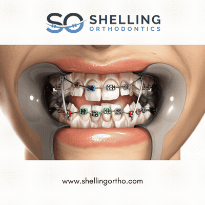 An Advertisement For Shelling Orthodontics Shows A Woman With Braces GIF