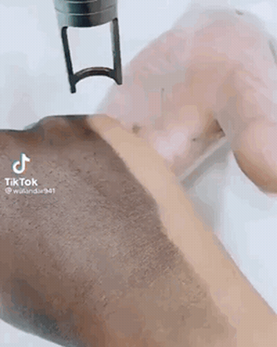Close Up Of Arm With Laser GIF