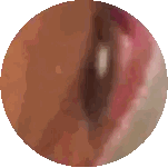 Close Up Of Eye With Red Spot Sticker
