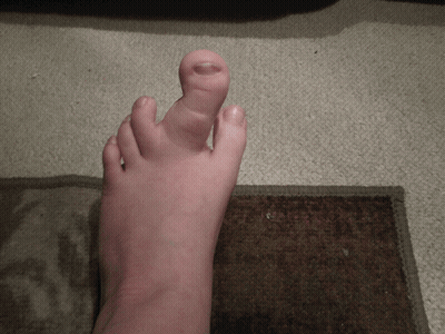 Close Up Of Foot With Missing Toe GIF