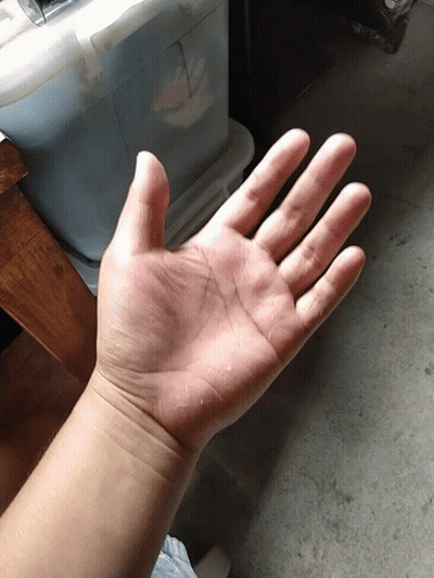 Close Up of Hand With Spots