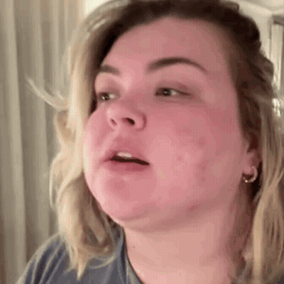 Close Up Of Woman Face With Red Rash GIF