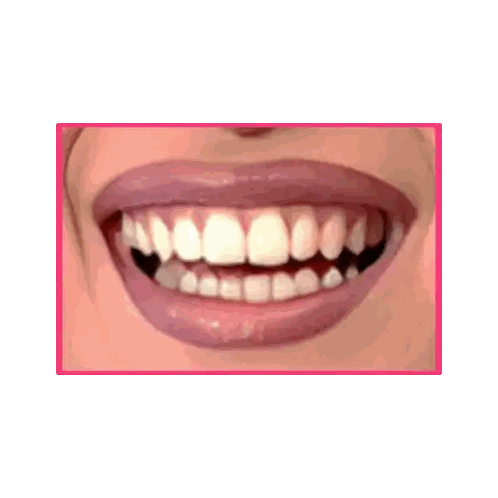 Close Up Of Woman's Teeth With Pink Lip Color Sticker