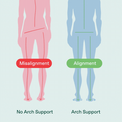 Diagram Person With Misalignment And Arch Support GIF