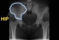 Hip Hip Hooray Pelvic Xray GIF