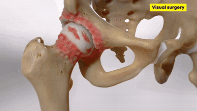 Hip Joint Model with Yellow Sticker Visual Surgery