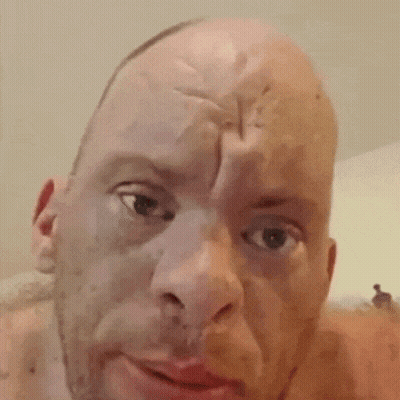 Man With Huge Bump On Head GIF
