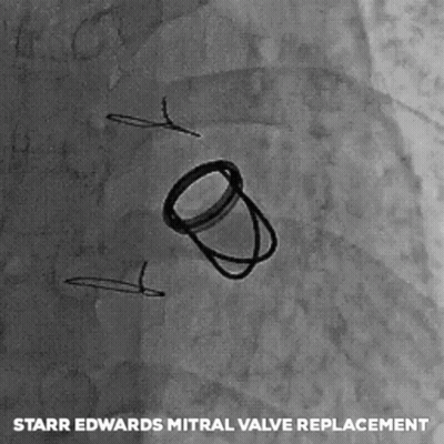 Starr Edwards Mitral Valve Replacement Drawing GIF