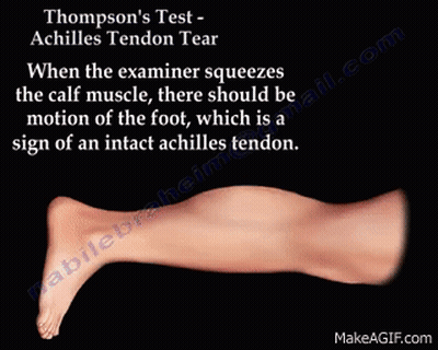 Thompson's Test Achilles Tendon Tear Squeezing Calf Muscle GIF