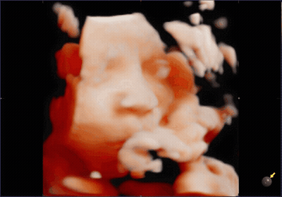 Ultrasound Baby Face With Yellow Arrow Pointing To Object GIF